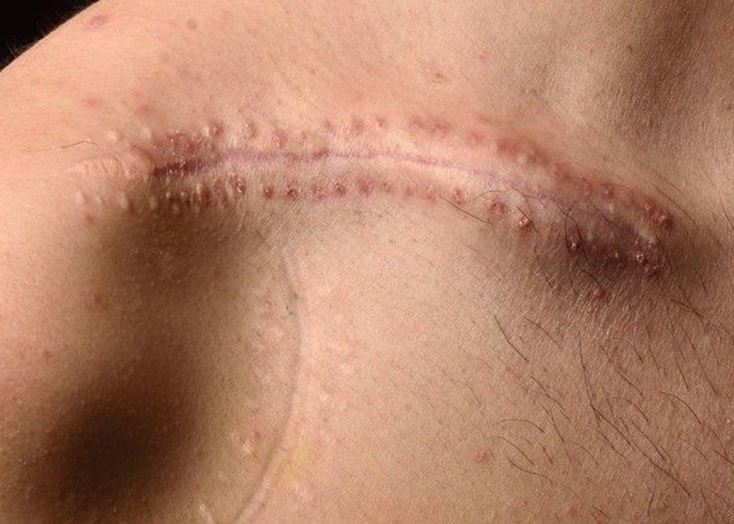 Scarring Masterclass - Part 2