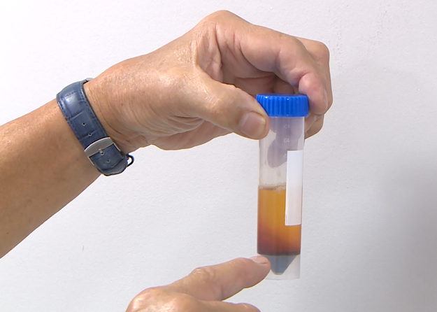 Practical 1 Drawing Blood and Protein Rich Plasma Extraction